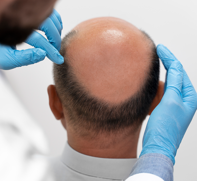 Greffe-de-cheveux